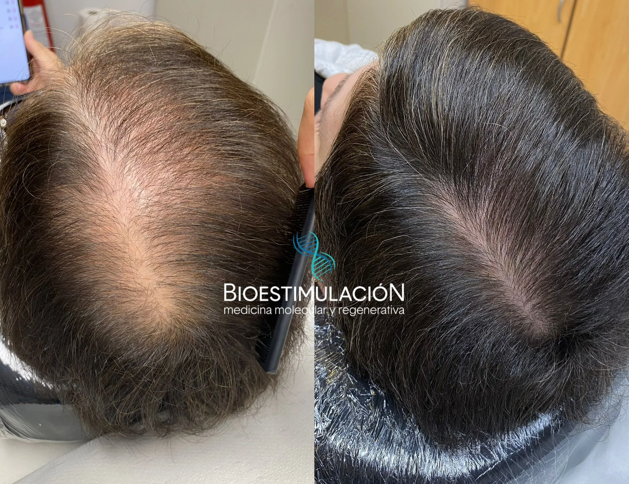 Resultado de salud capilar - Bioestimulación